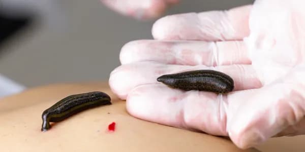 Hirudoterapi (Sülük)